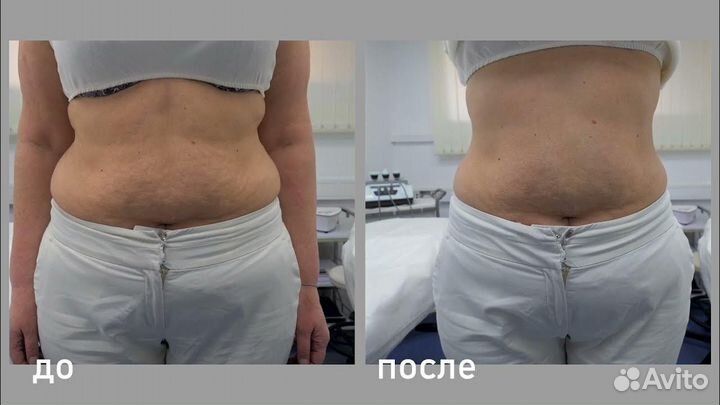 Супер коррекция фигуры УЗ Кавитация+ РФ Лифтинг