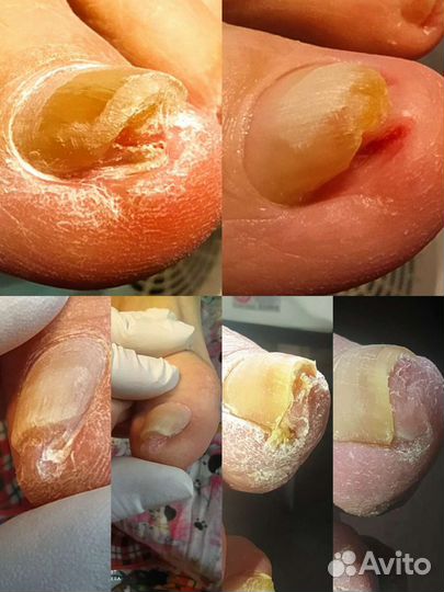 Мед. Педикюр1500/Титан1500