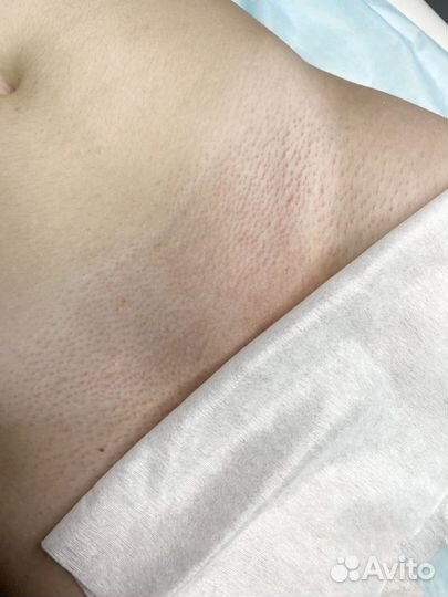 Депиляция/электроэпиляция