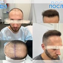 Пересадка волос / бороды / бровей, Шатура