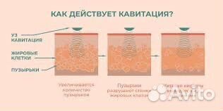 RF лифтинг, Кавитация/ похудение омоложение