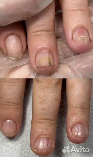 Восстановление ногтей из различных состояний