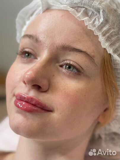 Увеличение губ / Косметолог