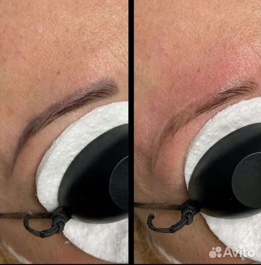 Удаление татуажа