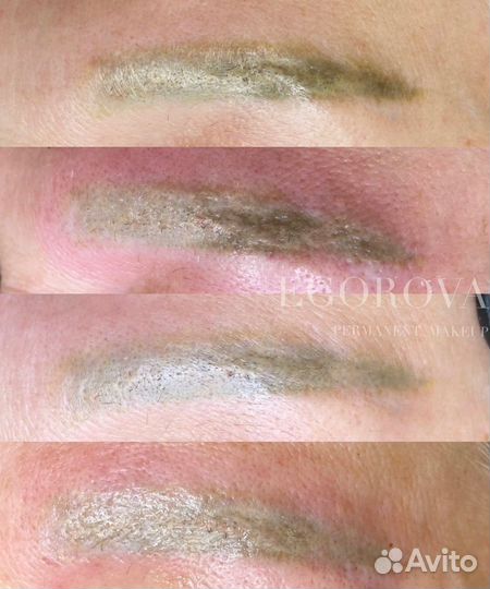 Удаление татуажа ремувером