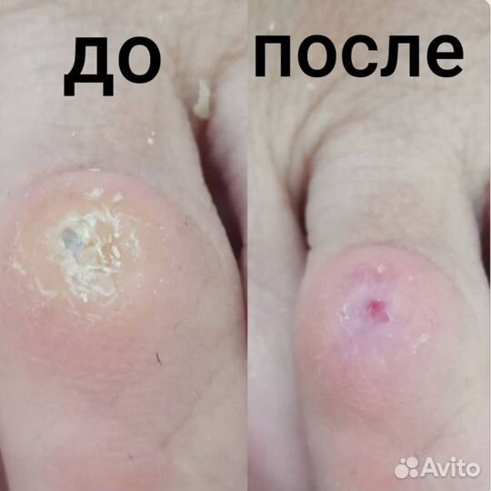 Удаление мозоли подолог Одинцово