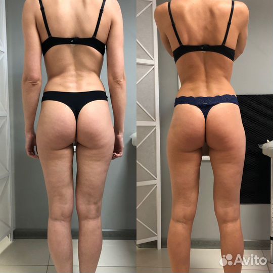 Rf лифтинг,Уз кавитация