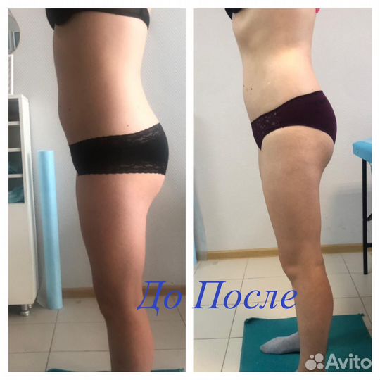 Антицеллюлитный массаж