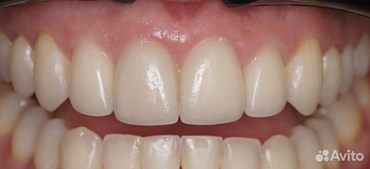 Услуги зубного техника