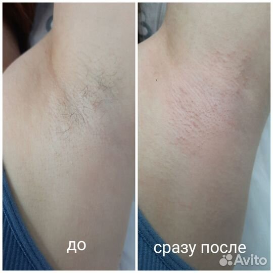 Электроэпиляция