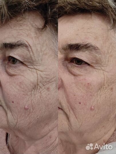 Массаж ручной Массаж lpg Косметолог