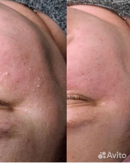 Чистка лица, пилинг, уход, на премиум препаратах