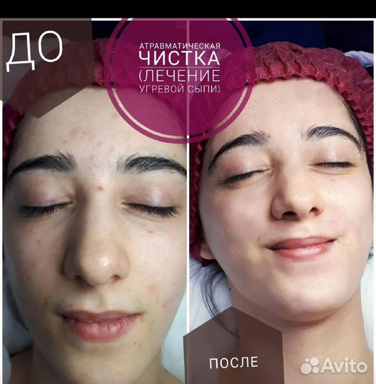 Косметолог чистка лица