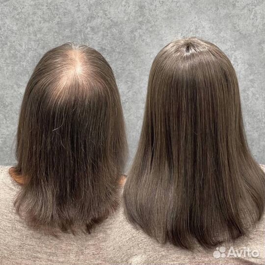 Установка систем замещения волос