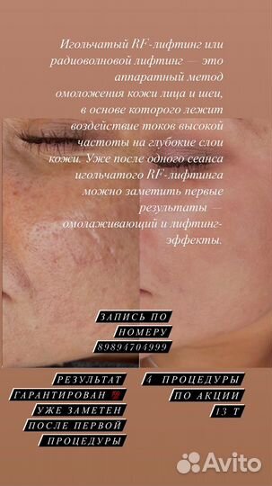 Микроигольчатый RF-лифтинг