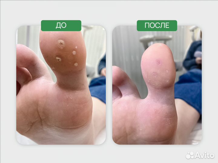 Подолог, вросшие ногти, медицинский педикюр