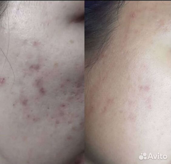 Механическая чистка лица