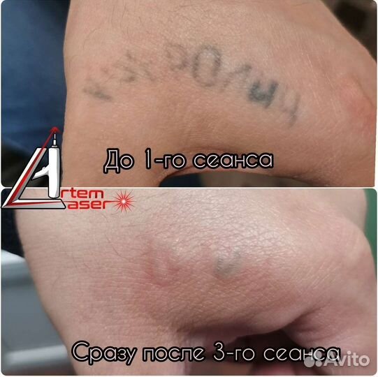 Лазерное удаление тату и татуажа