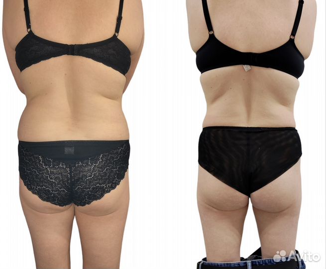 Антицеллюлитный массаж