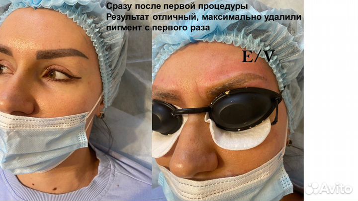 Удаление татуажа,тату, пигментации, шрамов на лица