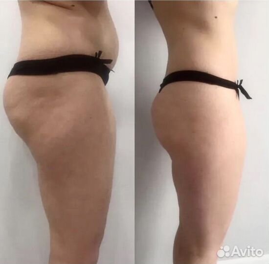 Армопластика