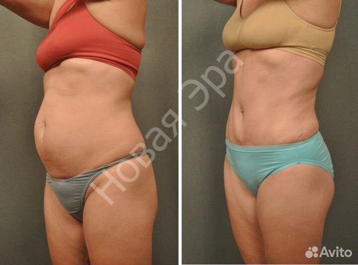 Убрать живот, сбросить вес. Заморозка жира