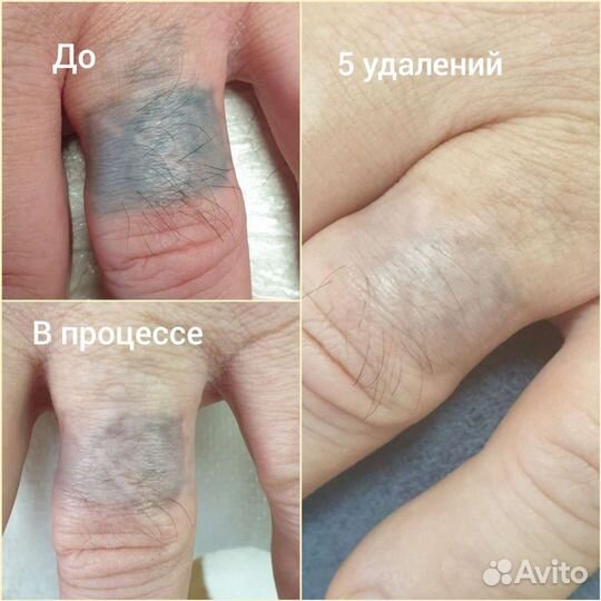 Удаление тату/татуажа