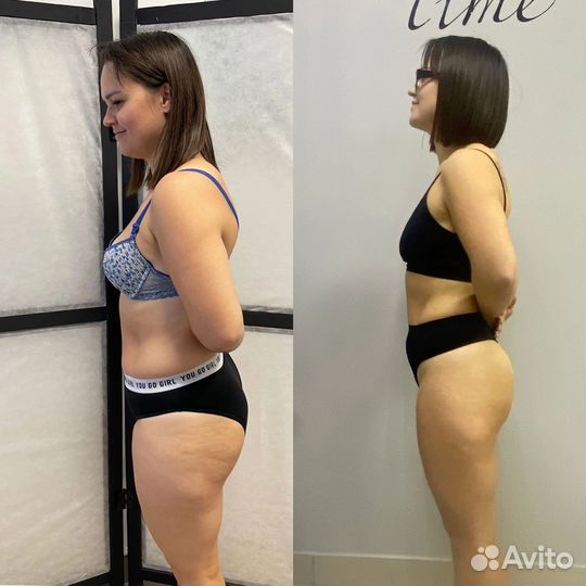 Криолиполиз процедура