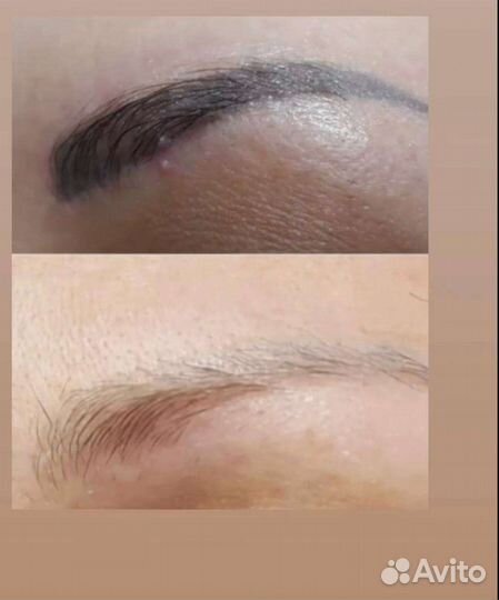 Удаление тату/татуажа лазером