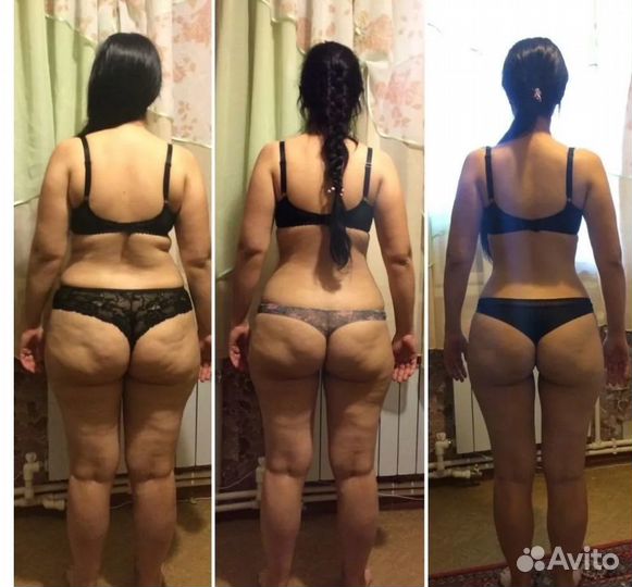 Удаление жира,эндосфера, липолазер