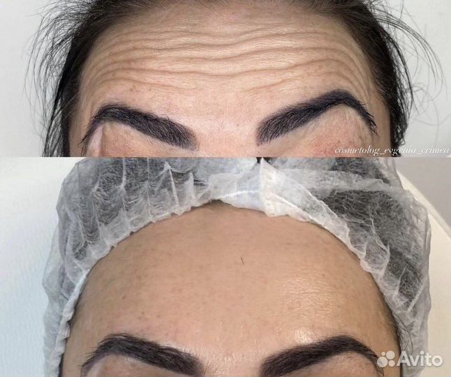 Ботокс для лица