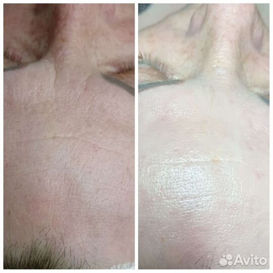 Чистка лица, эстетическая косметология