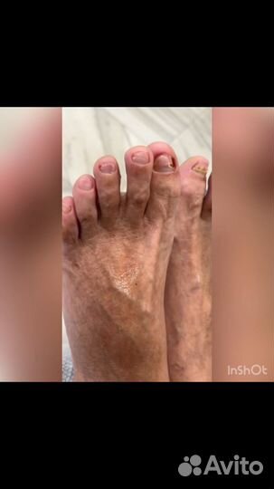 Лечение грибка ногтей