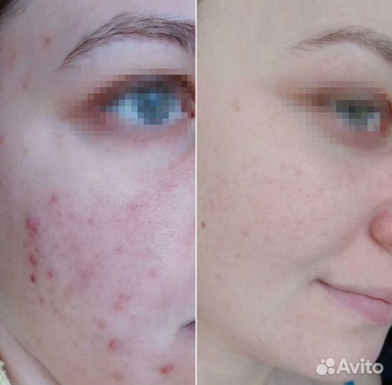 Лечение акне и постакне аппаратное