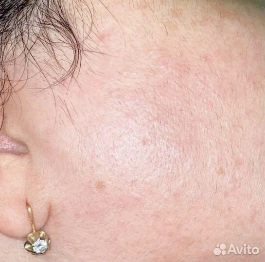 Электроэпиляция Apilus