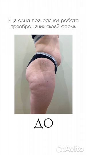 Ультразвуковая Кавитация,быстрое похудение