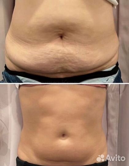 Массаж LPG Кавитация Вибромассаж Обучение