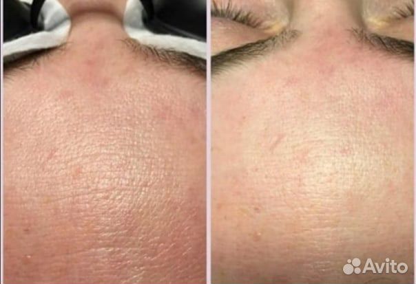 Карбоновый пилинг