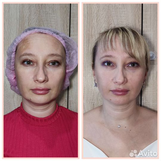 Лифтинг лица и тела
