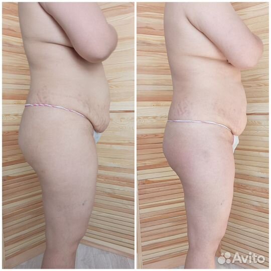 Коррекция фигуры/ RF-лифтинг/ Микротоки/ Кавитация