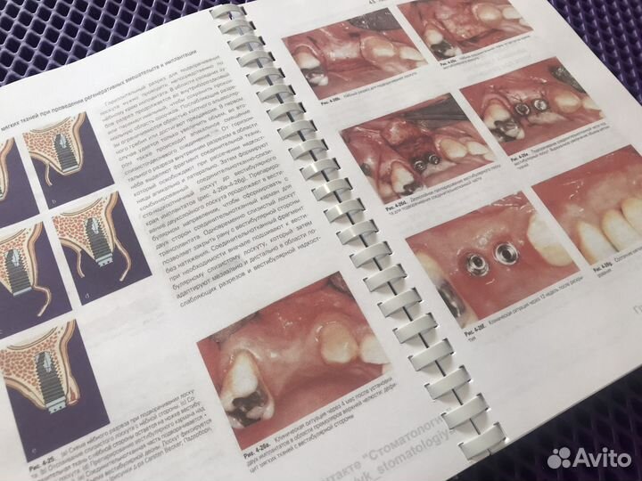 Регенеративные методы в имплантологии