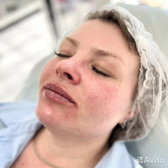 Биоревитализация