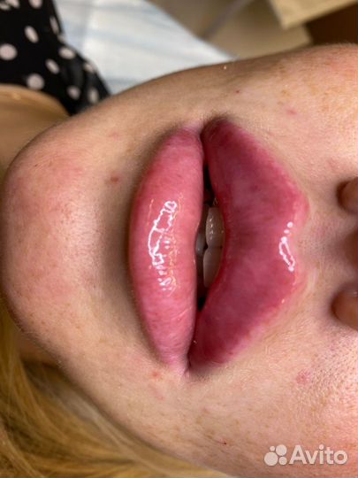 Модель на увеличения губ