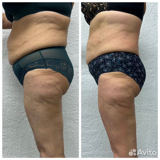 Аппаратный Sketch массаж тела лица