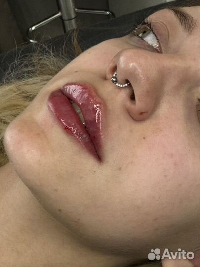 Плазмолифтинг