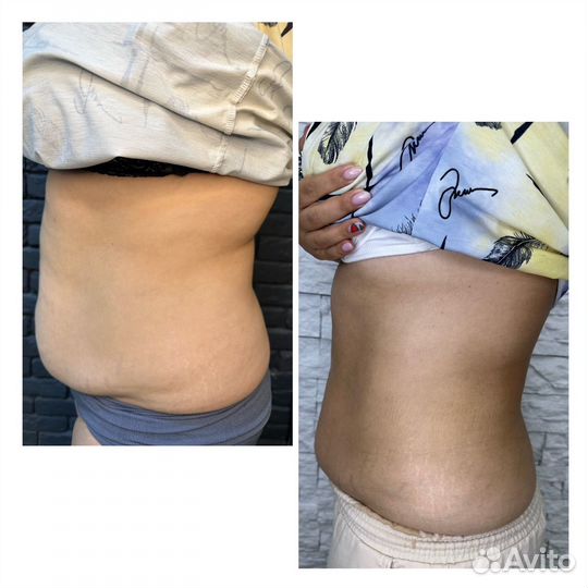 Ультразвуковая Кавитация Тела