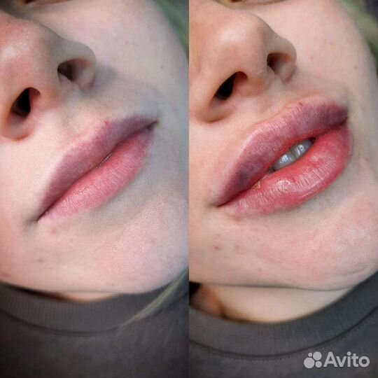 Косметолог/чистка лица/увеличение губ/ботокс/нити