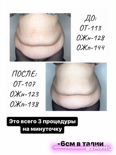 Тейпирование