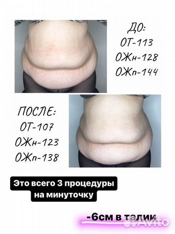 Тейпирование