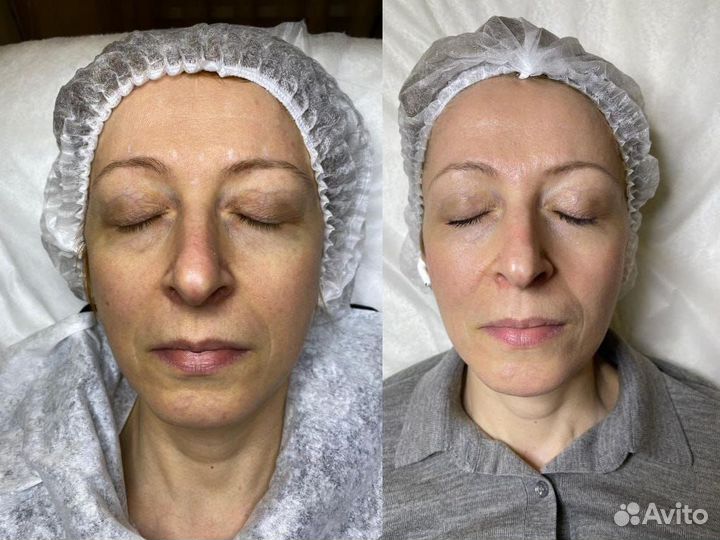 Требуются модели на Smas лифтинг